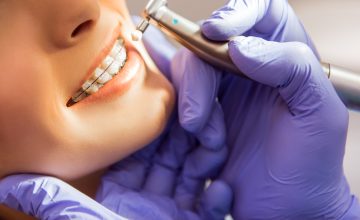 Close-up. Girl with braces on the teeth, at a reception at the dentist